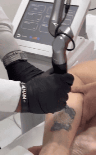 Picsecond Laser - Image 3